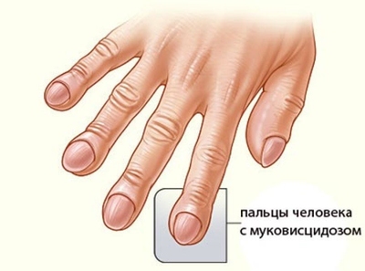 После выявления заболевания «муковисцидоз»