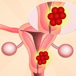 Можно ли забеременеть при эндометриозе матки и родить
