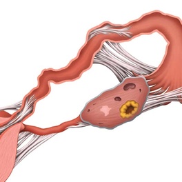 Непроходимость маточных труб
